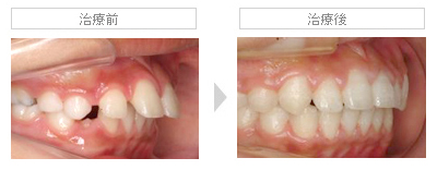 上顎前突（出っ歯）　治療前・治療後の比較